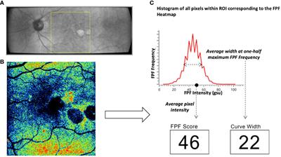 Flavoprotein fluorescence elevation is a marker of mitochondrial oxidative stress in patients with retinal disease